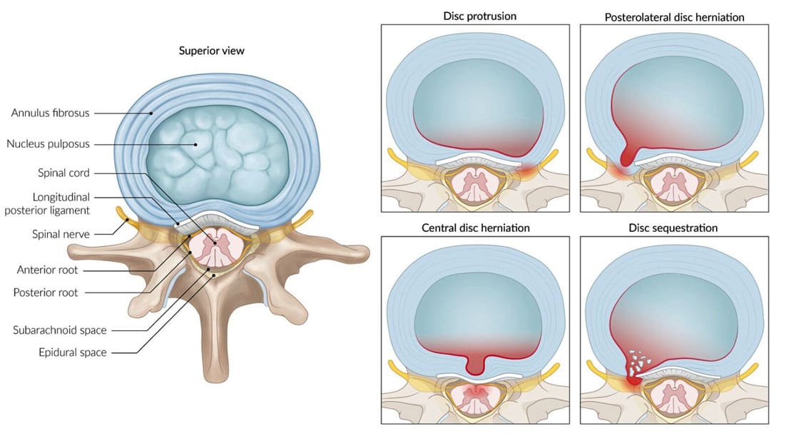 The Inner Core: Nucleus Pulposus and Spinal Discs
