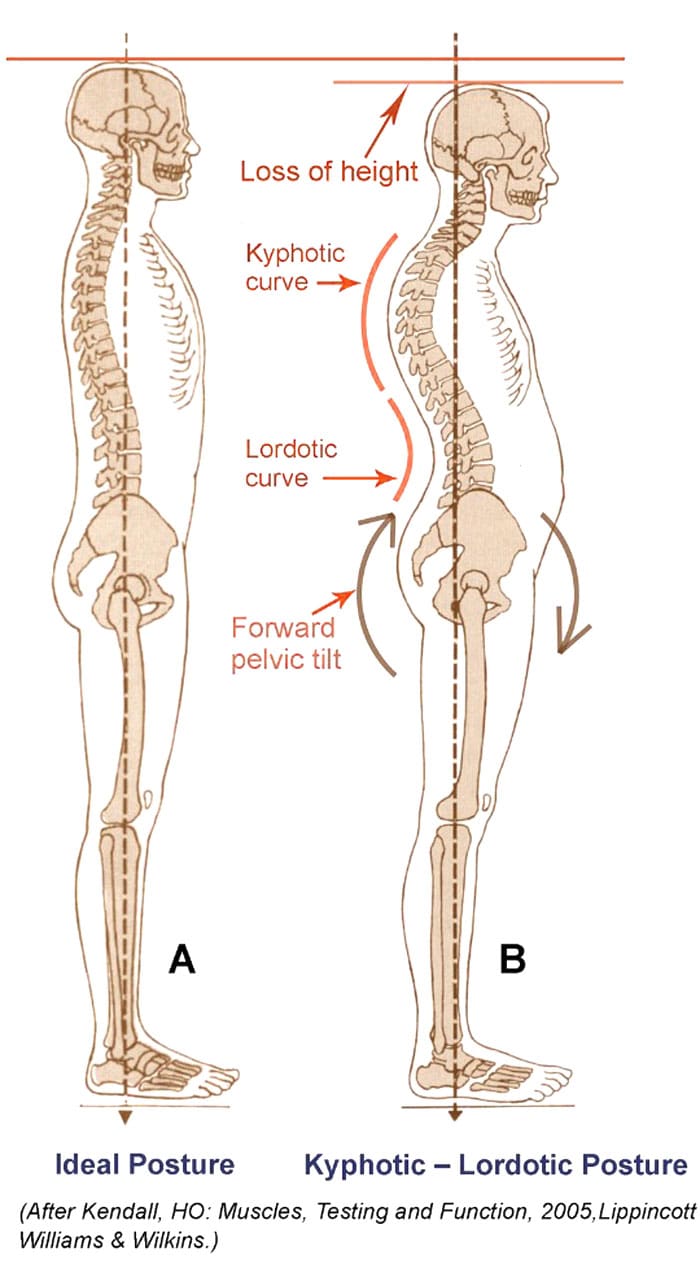 Understanding Swayback Posture and Its Effects on the Body