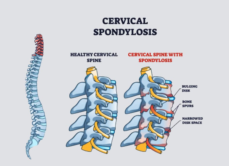 Managing Cervical Arthritis: Effective Strategies and Therapies