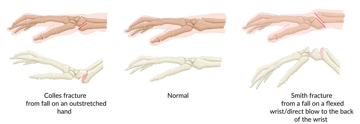 The Anatomy of Colles' Fracture: How it Happens and How to Heal