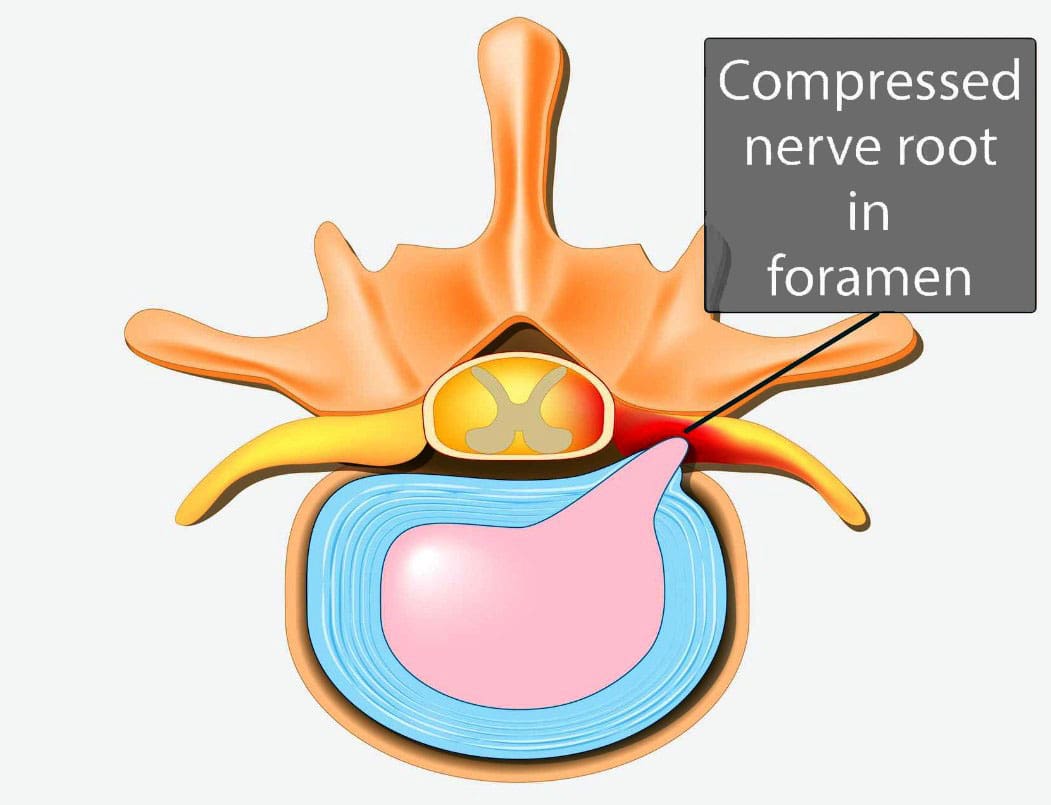 Managing Nerve Root Encroachment with Surgical Decompression