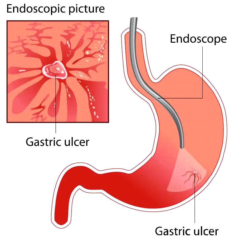 The Connection Between NSAIDs and Peptic Ulcers