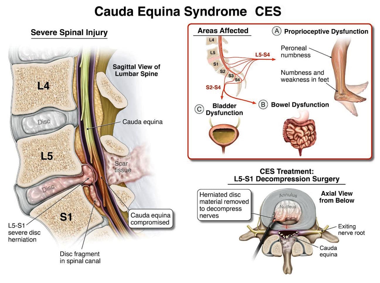 Cauda Equina Symptoms and Urgency for Treatment