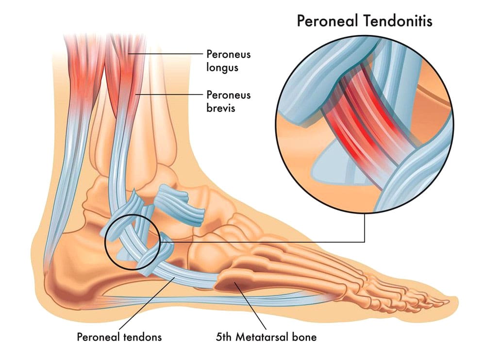 Peroneal Tendon Damage: Causes and Treatment