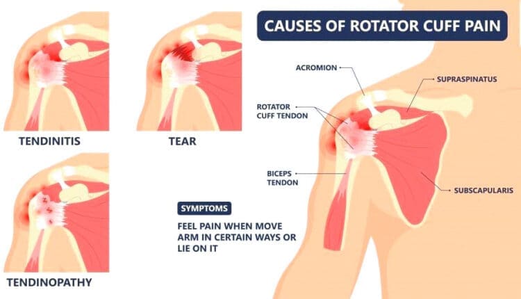 How to Manage Rotator Cuff Tears: A Comprehensive Guide
