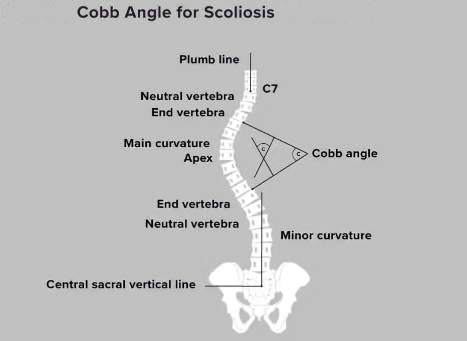 Cobb Angle: Understanding Spinal Curvature Measurement