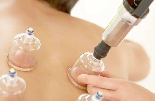 Cupping: The Alternative Treatment for Pain Relief